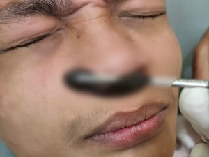 Mengejutkan Lintah Segede Jempol Tinggal di Hidung Pria 2 Pekan