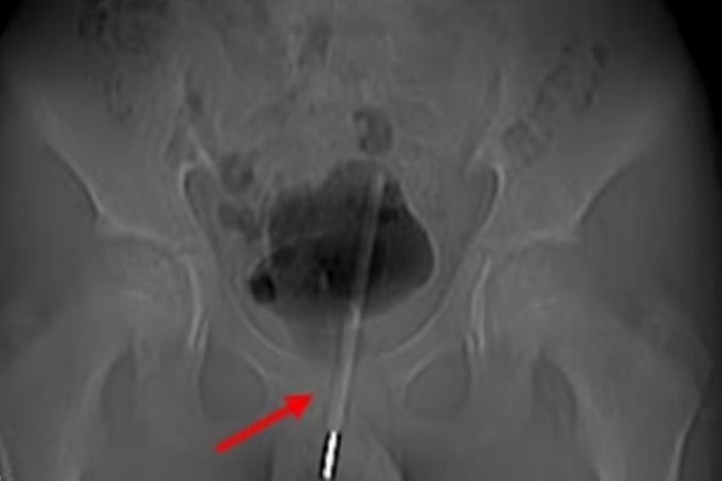 Operasi termometer Termometer masuk ke dalam penis remaja laki-laki.