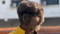 Patidar, yang tinggal di Nandleta di Madhya Pradesh, didiagnosis mengidap hipertrikosis, yang didefinisikan oleh National Library of Medicine sebagai pertumbuhan rambut berlebihan di bagian tubuh mana pun. (Foto: Instagram@lalitpatidar520)