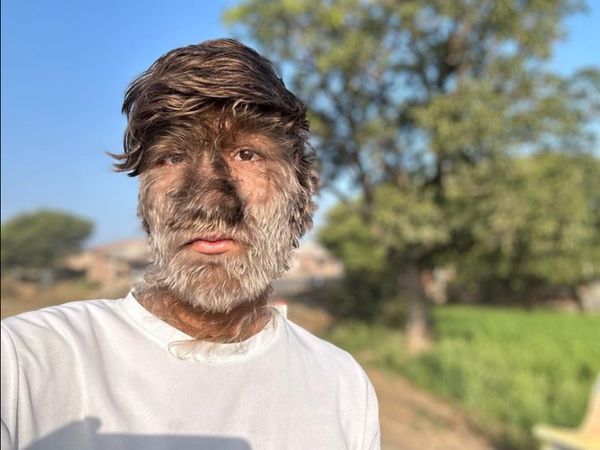 6 Foto Remaja India Kena Kondisi Langka, Wajahnya Tertutup Rambut Bak Serigala