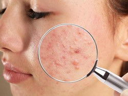 Skincare Tak Mempan? Ini Treatment yang Bikin Bekas Jerawat Cepat Pudar