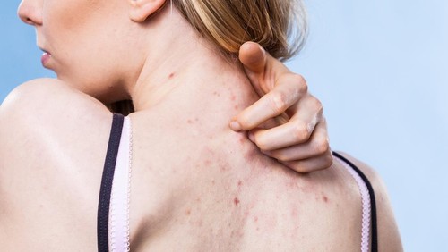 Penyebab Jerawat di Punggung