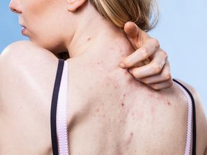 8 Penyebab Jerawat di Punggung dan Cara Mengatasinya