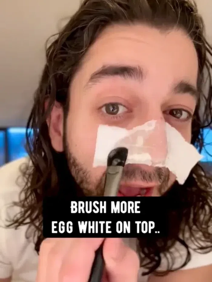 Viral hilangkan komedo pakai telur