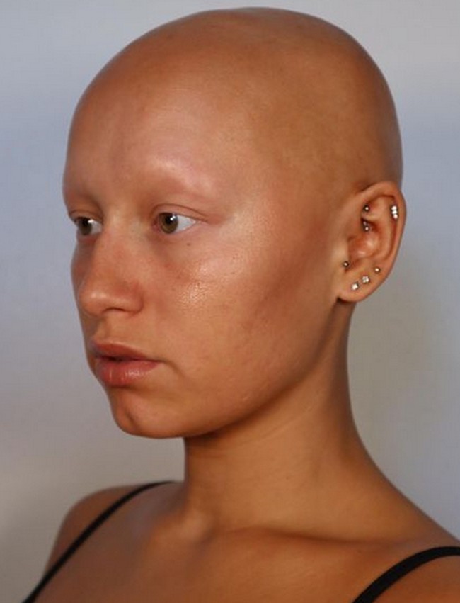 Wanita 24 tahun itu mengalami alopecia sejak bayi dengan garis rambut ke belakang. Semakin lama rambutnya makin rontok hingga menjadi botak.Foto: dok. Instagram