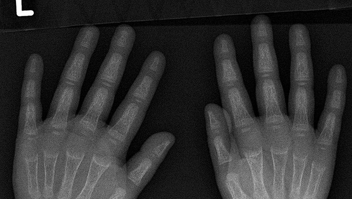 Osteomalasia Adalah: Pengertian, Penyebab, Serta Pengobatannya