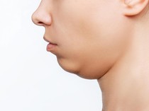 Cara Menghilangkan Double Chin dengan dan Tanpa Operasi