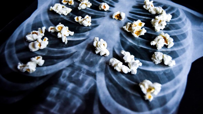 Pieces of popcorn on an x-ray printout of a human rib cage to depict the medical condition bronchiolitis obliterans, better known as 