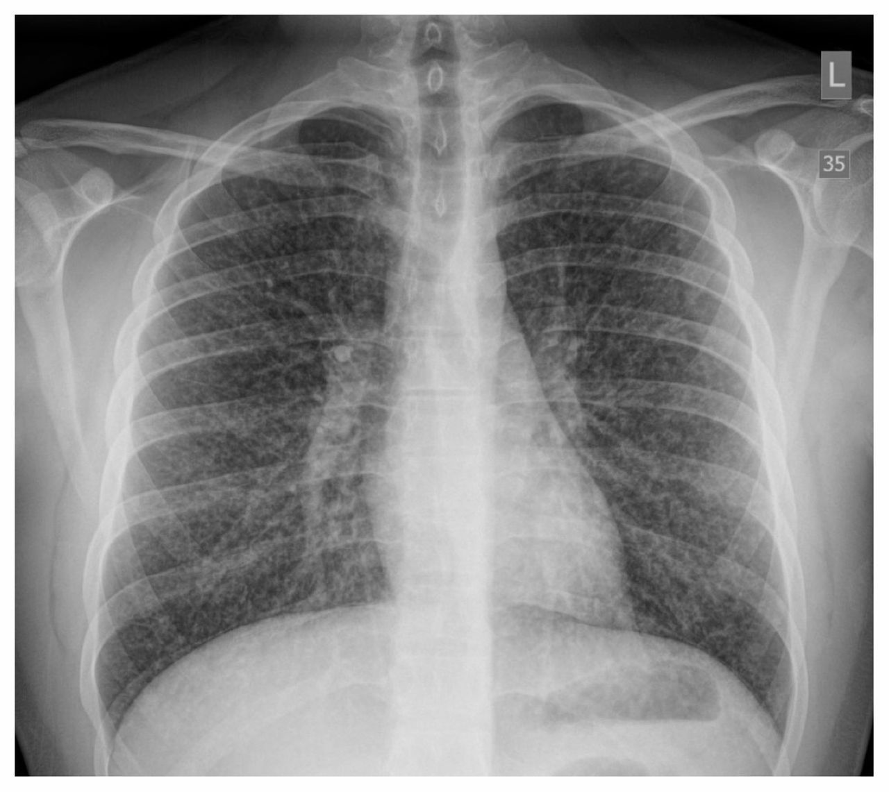 Penampakan Xray Paru Vapers yang Kena 'Popcorn Lung'