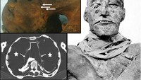 Ramses III dari Dinasti ke-20 (1186 hingga 1155 SM). Pemindaian CT Ramses III mengungkapkan bahwa dia terbunuh dalam konspirasi harem yang didalangi oleh istri keduanya, Tiye, untuk menempatkan putranya Pentawer yang berusia 18 tahun di atas takhta alih-alih ahli waris yang sah, Ramses IV. Pemindaian menunjukkan bahwa raja memiliki banyak luka: luka potong yang fatal di leher serta jempol kaki kiri yang diamputasi. Sebelum dilakukan pemindaian, penyebab kematian Ramses III belum dapat dipastikan. (Foto: Mumi Firaun Ramses III via BMJ)