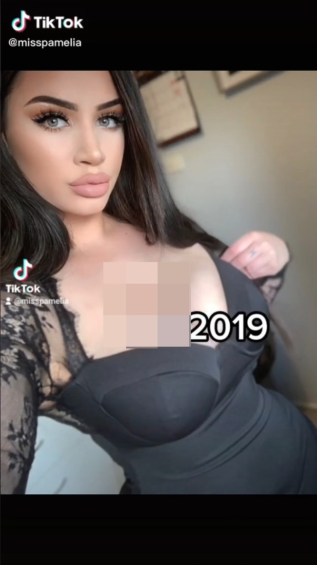 Gigantomastia yang menyebabkan payudara Pamelia membesar 18 cm dalam delapan bulan terakhir biasanya disebabkan karena perubahan hormon, pemakaian obat, atau penyakit autoimun. Tapi pada kasus Pamelia, belum diketahui secara pasti ada pemicunya. Foto: TikTok Pamelia J