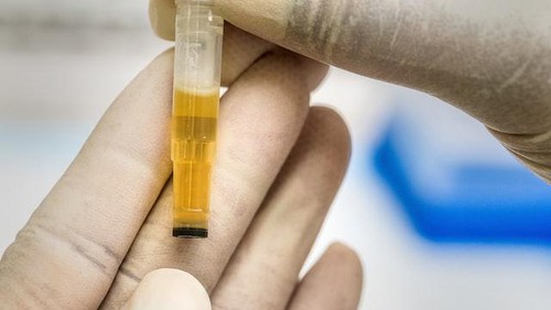 Ilustrasi tes albumin dalam urine.