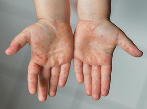 Campak Bisa Berujung Kematian, Pakar: Jangan Dianggap Sepele