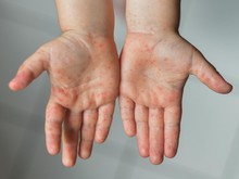 20 Anak Meninggal Akibat Campak Sumenep, Ini Kata Menkes