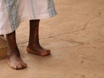 Waspada Penyakit Kusta! Kenali Gejala, Penyebab, dan Cara Mengobatinya