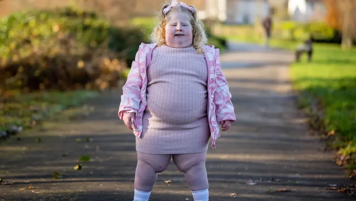 Harlow obesitas sindrom prader-willi