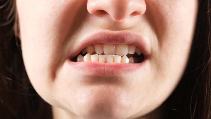 Patient with dislocated jaw and malocclusion, temporomandibular joint dysfunction, close-up