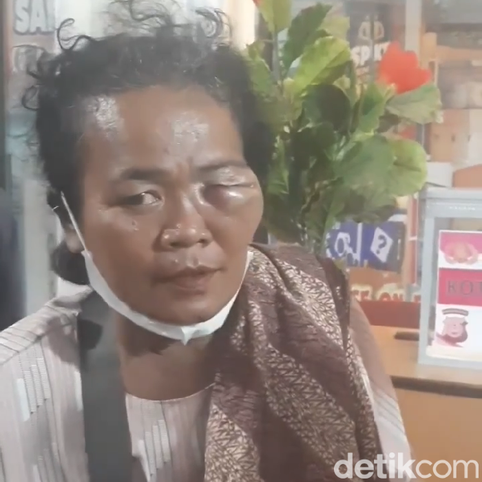 Seorang wanita di Pematang Siantar, Sumut diduga dipukul sekuriti PTPN 3 sampai wajahnya bengkak.