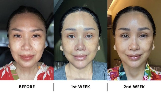 Titi DJ secara terang-terangan melakukan operasi plastik di Korea Selatan. Dalam unggahannya seminggu yang lalu, penyanyi 56 tahun itu memperlihatkan foto sebelum operasi plastik dan penampakan dua minggu setelah operasi plastik. Foto: Instagram Titi DJ