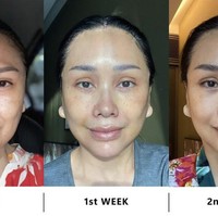 Titi DJ secara terang-terangan melakukan operasi plastik di Korea Selatan. Dalam unggahannya seminggu yang lalu, penyanyi 56 tahun itu memperlihatkan foto sebelum operasi plastik dan penampakan dua minggu setelah operasi plastik. Foto: Instagram Titi DJ