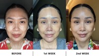 Usai melalui operasi, Titi membagikan foto perubahan wajahnya dari sebelum operasi hingga minggu kedua setelah melalui prosedur operasi anti aging. Foto: Instagram Titi DJ