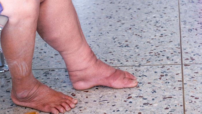 Penyakit Kaki Gajah Masih Hantui Warga RI, Ada 7 Ribu Kasus di 2023