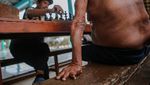 Mampukah Indonesia Mengeliminasi Penyakit Kusta di 2024?