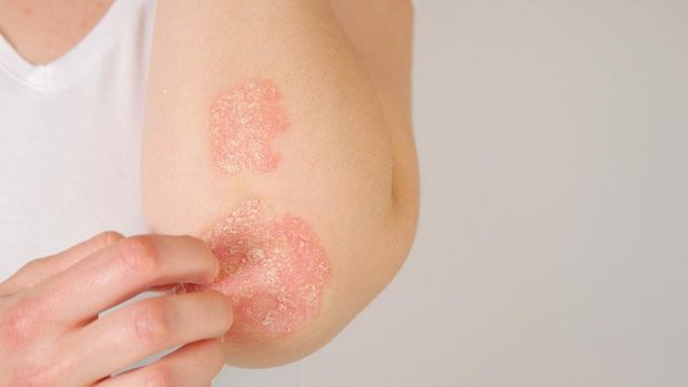CLOSE UP: Unrecognizable young woman suffering from autoimmune incurable dermatological skin disease called psoriasis. Female gently scratching red, inflamed, scaly rash on elbows. Psoriatic arthritis