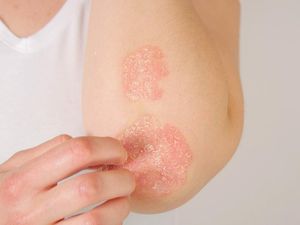 Psoriasis Bikin Kulit Gatal dan Bersisik, Bagaimana Mengobatinya Dok?
