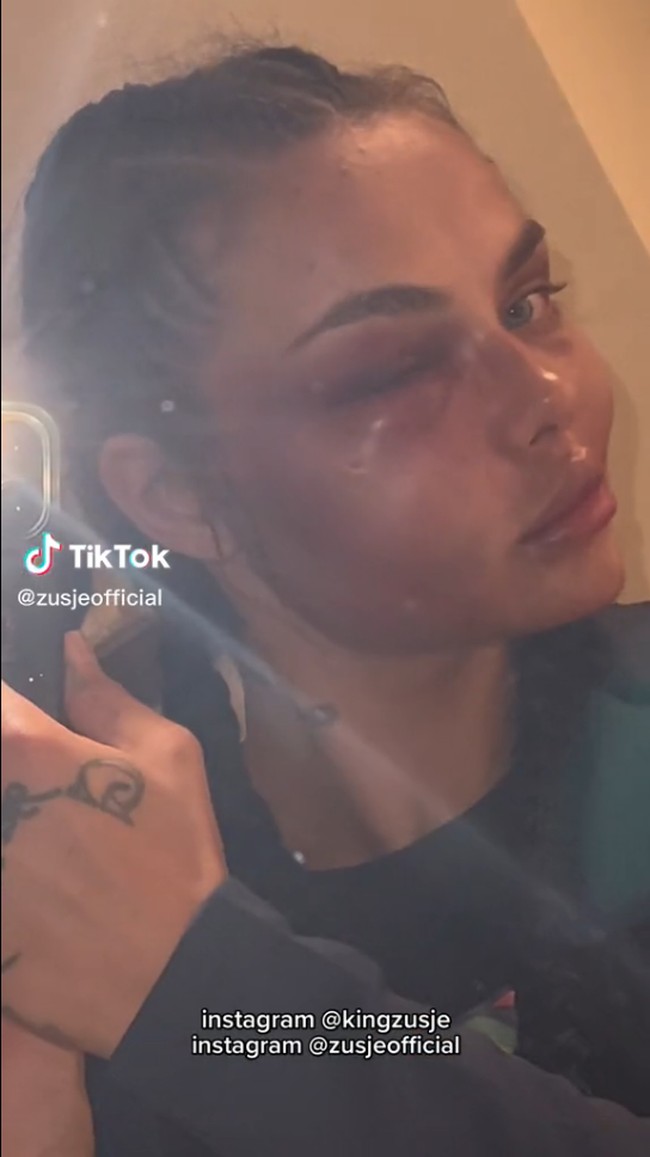 Untuk kalian yang bertanya ini terjadi di ronde pertama. Aku bertarung jarak penuh dengan mata seperti ini, aku kehilangan hanya satu poin, tulisnya di Instagram. Foto: TikTok/Instagram Kamila Smogulecka