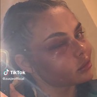 Untuk kalian yang bertanya ini terjadi di ronde pertama. Aku bertarung jarak penuh dengan mata seperti ini, aku kehilangan hanya satu poin, tulisnya di Instagram. Foto: TikTok/Instagram Kamila Smogulecka
