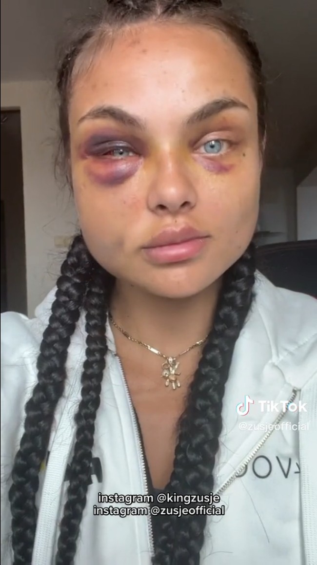 Dalam video, proses penyembuhannya tampak singkat. Padahal Kamila membutuhkan waktu hampir sebulan untuk menghilangkan bengkak dan lukanya. Foto: TikTok/Instagram Kamila Smogulecka