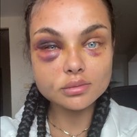 Dalam video, proses penyembuhannya tampak singkat. Padahal Kamila membutuhkan waktu hampir sebulan untuk menghilangkan bengkak dan lukanya. Foto: TikTok/Instagram Kamila Smogulecka