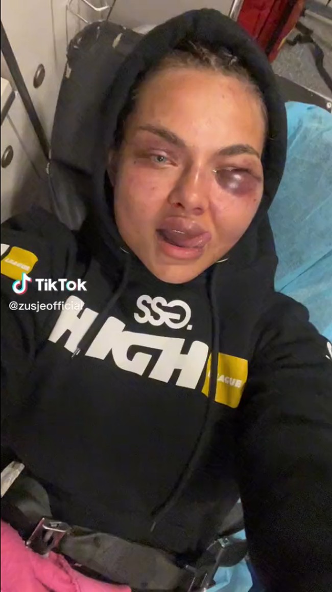 Kamila atau Zusje menampilkan bukti-bukti kebrutalan laganya melawan Marta Linkiewicz di Instagram. Wanita asal Polandia itu terlihat bengkak di bagian mata hingga bola matanya tampak berdarah. Dalam video, Zusje tampak berusaha mengobatinya dengan kompres sebelum akhirnya berdandan cantik untuk sebuah acara. Foto: TikTok/Instagram Kamila Smogulecka