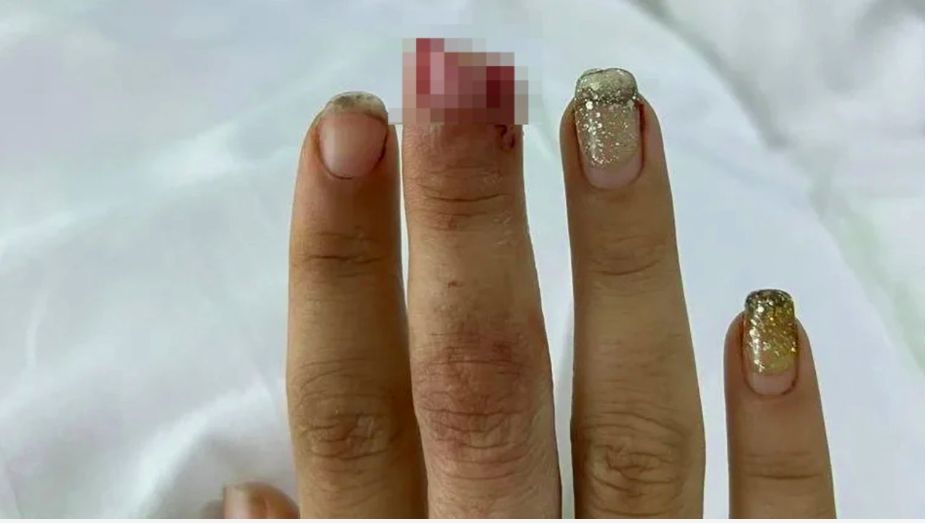 Turis gigit jari wanita Inggris sampai putus