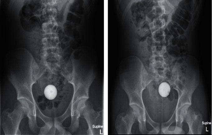 Bola golf tersangkut di usus Bola golf tersangkut di usus