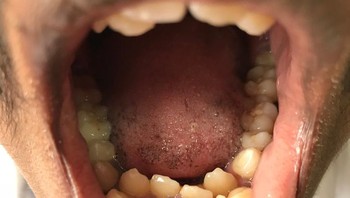 Hyperdontia adalah suatu kondisi di mana gigi tambahan tumbuh di dalam mulut, biasanya di lokasi di belakang atau di dekat gigi sulung atau permanen biasa. Jadi ada orang yang jumlah giginya melebihi standar 32. Beberapa kasus hyperdontia tidak memerlukan perawatan, sementara yang lain memerlukan pencabutan gigi ekstra. Foto: Brightside