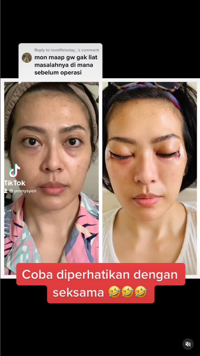 Wanita tersebut pun menyampaikan bahwa ia memang sengaja memilih bentuk yang natural. Mungkin hal itu yang membuat perubahannya tidak terlalu dramatis. Yang natural saja dok. Nggak mau yang lebay kayak Barbie kok, yang penting napasnya lega dan nggak mau pakai implan, tulis Yenny.Foto: Instagram/TikTok @yennysyen