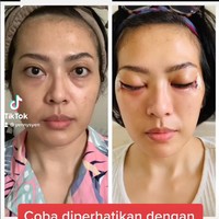Wanita tersebut pun menyampaikan bahwa ia memang sengaja memilih bentuk yang natural. Mungkin hal itu yang membuat perubahannya tidak terlalu dramatis. Yang natural saja dok. Nggak mau yang lebay kayak Barbie kok, yang penting napasnya lega dan nggak mau pakai implan, tulis Yenny.Foto: Instagram/TikTok @yennysyen