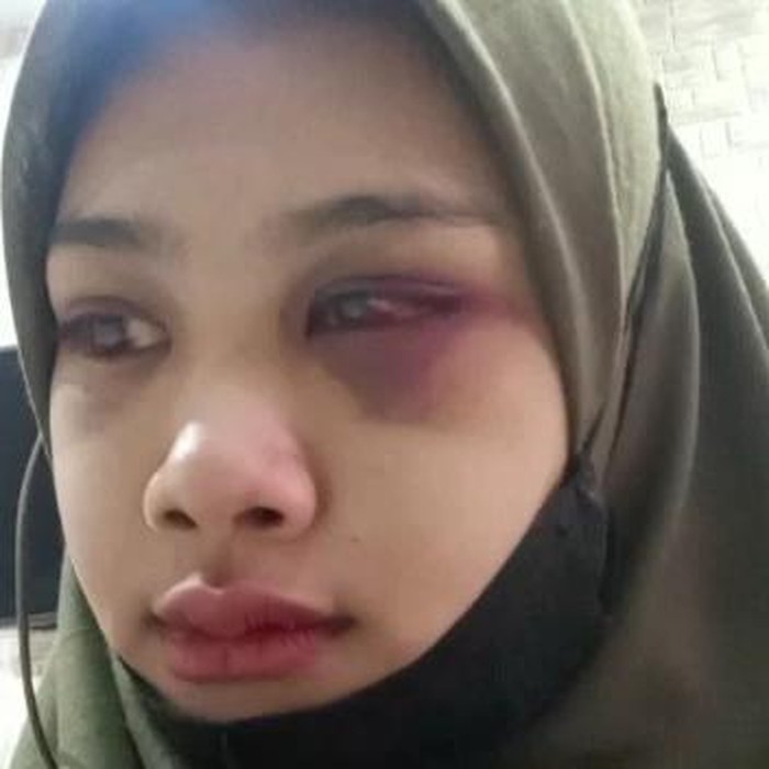 Kondisi Prita Agneta yang babak belur dihajar suaminya Ahmad Rifah Hilfansyah