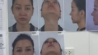 Dikutip dari Mayo Clinic, Lucinta melakukan rhinoplasty atau operasi yang mengubah bentuk hidung. Rhinoplasty memiliki risiko yang cukup serius seperti berdarah, infeksi, dan reaksi merugikan terhadap anestesi. Namun, risiko dan komplikasi jarang terjadi. (Foto: Tiktok @lucintaluna12)