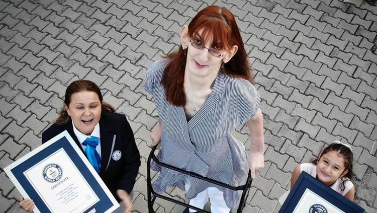 Potret Rumeysa Gelgi, Punya Tinggi Lebih 2 Meter gegara Penyakit Langka