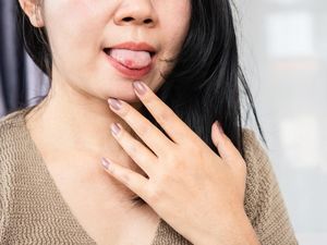 10 Cara Mengobati Sariawan di Rumah dengan Mudah