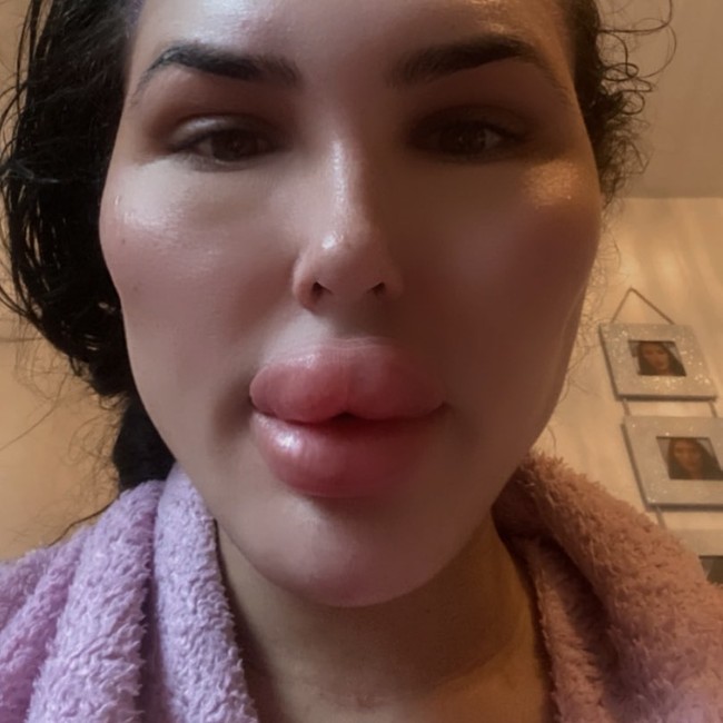 Sofia Lips ingin punya bibir terbesar di Inggris sebelum mencapai targetnya sebagai pemiliki bibir terbesar di dunia. Sejauh ini, ukuran bibirnya sudah membesar hampir dua kali lipat. Foto: Instagram Sofia Lips