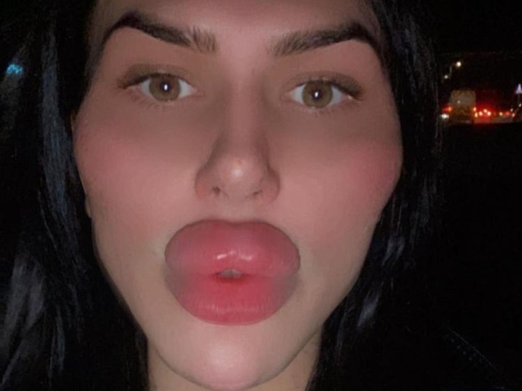 8 Foto Selebgram Terobsesi Oplas Sampai Diblokir Dokter, Bibirnya Jadi Begini