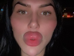 8 Foto Selebgram Terobsesi Oplas Sampai Diblokir Dokter, Bibirnya Jadi Begini