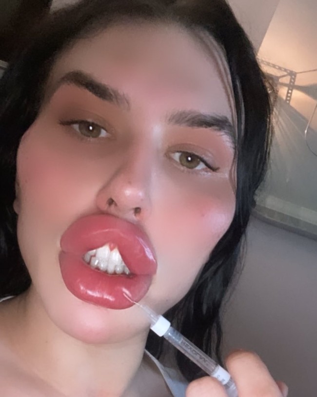 Selebgram tersebut mengaku tidak pedulli dengan kata orang selagi ia menyuntikan lebih dari 100 ml filler pada bibirnya setiap dua bulan. Tak perlu pergi ke klinik, ia bahkan sering menginjeksinya sendiri. Foto: Instagram Sofia Lips