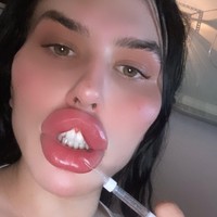 Selebgram tersebut mengaku tidak pedulli dengan kata orang selagi ia menyuntikan lebih dari 100 ml filler pada bibirnya setiap dua bulan. Tak perlu pergi ke klinik, ia bahkan sering menginjeksinya sendiri. Foto: Instagram Sofia Lips