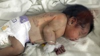 Baby Aya saat ini berada di rumah sakit di kota Afrin, Suriah, untuk menjalani perawatan. (Foto: AP/Ghaith Alsayed)