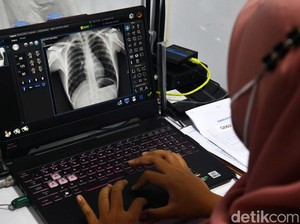 Klaim Menyesatkan Influencer Sebut TBC Bisa Dicegah-Diobati dengan Herbal